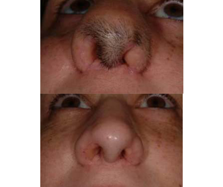Upper Lip Hair Removal treatment with laser