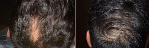 Platelet Rich Plasma (PRP) Therapy for Hair Loss - Pima Dermatology